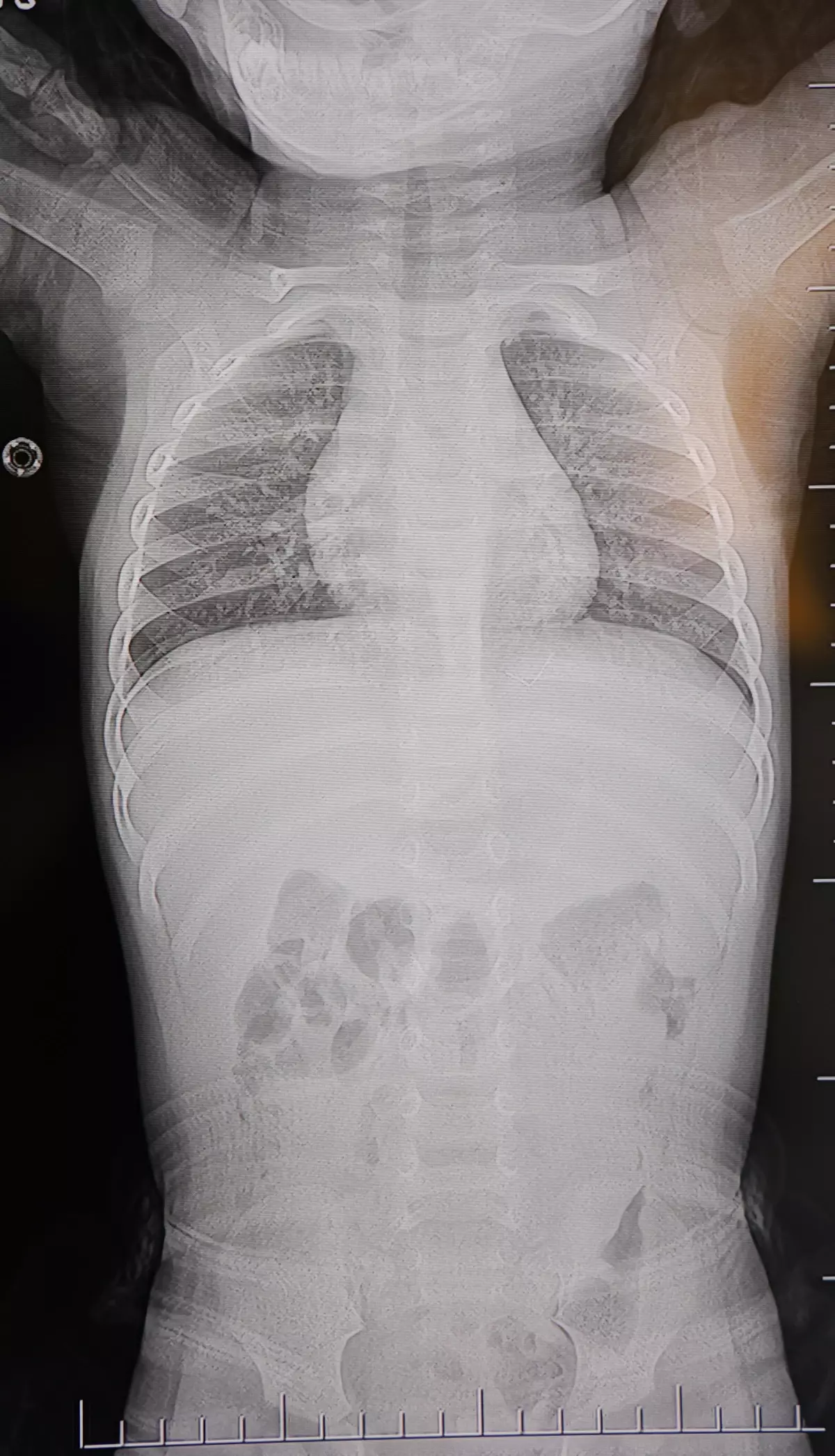 Kahramanmaraş'ta Bir Bebeğin Sırtından 2 Santimetrelik Zımba Teli Çıktı