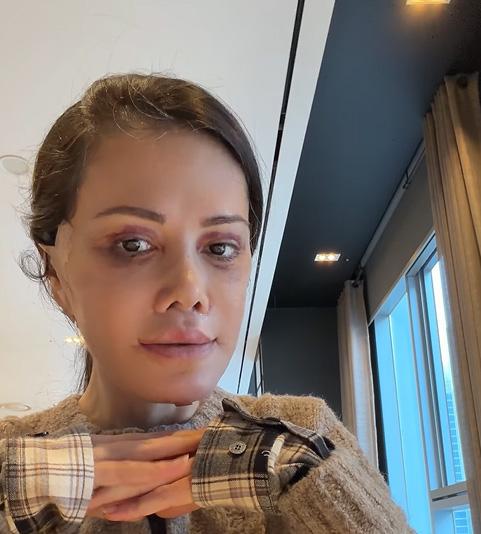 eski survivor yarismacisi didem ceran yuz nakli 19540055 3716 m