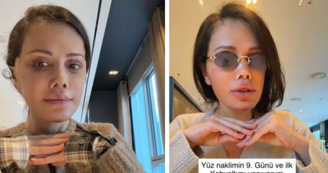 Survivor Didem Ceran kimdir, kaç yaşında? Didem Ceran yüz nakli mi yaptırdı, son hali nasıl?