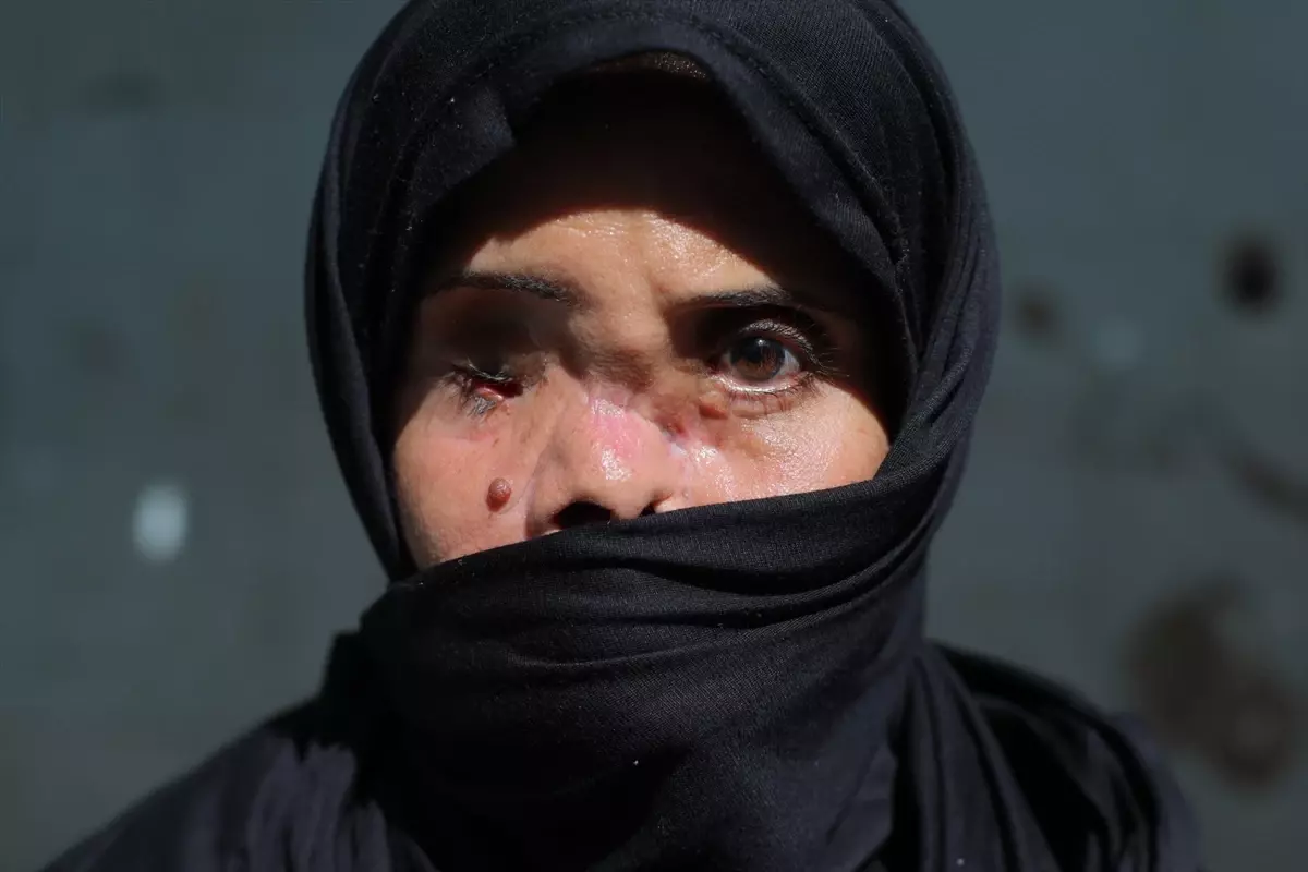 İsrail saldırısında yüzünün bir kısmını kaybeden Gazzeli annenin tek dileği çocuklarının korkmadan ona sarılması