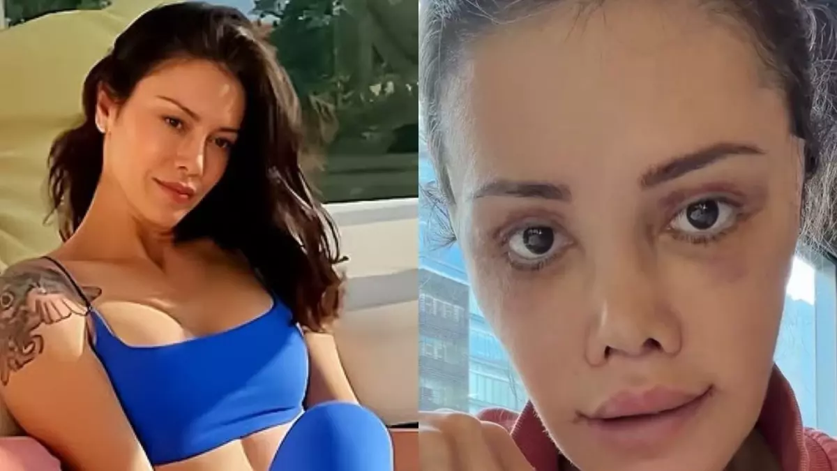 Yüz nakli yaptıran Didem Ceran'ın son hali: Harika gözüküyorum