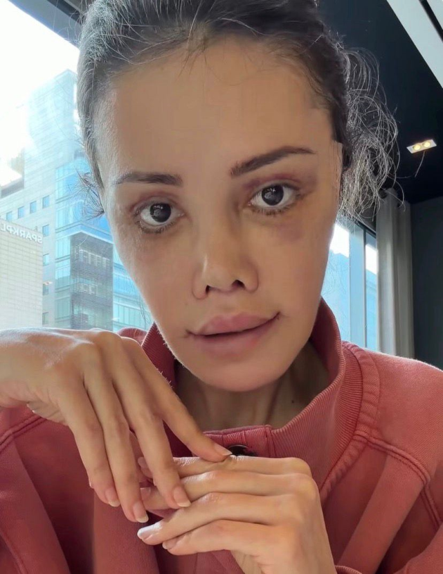 Didem Ceran's latest look after the face transplant: I look amazing