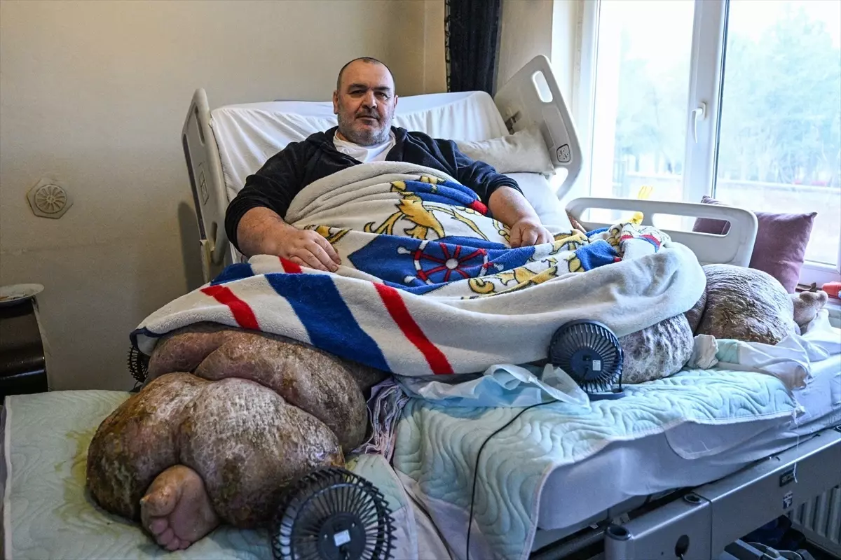 Kayseri'de yaklaşık 300 kiloluk fil hastası kişi, özel ekiple evinden çıkarılıp hastaneye sevk edildi