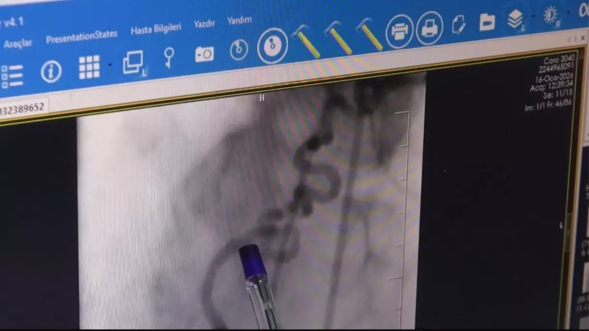 Hastanın kalbine giden kanı akciğere yönlendiren 'anormal damar' operasyonla kapatıldı
