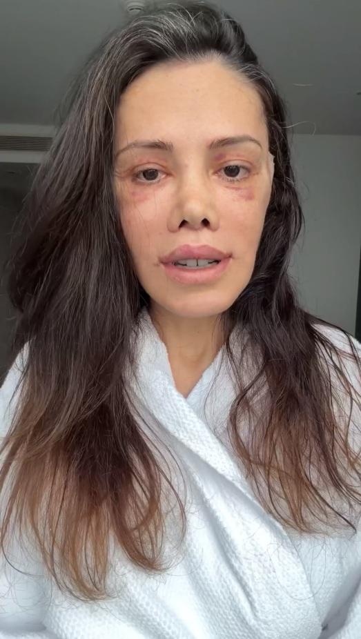 Didem Ceran stated that she has not taken a shower for 19 days after facial aesthetics