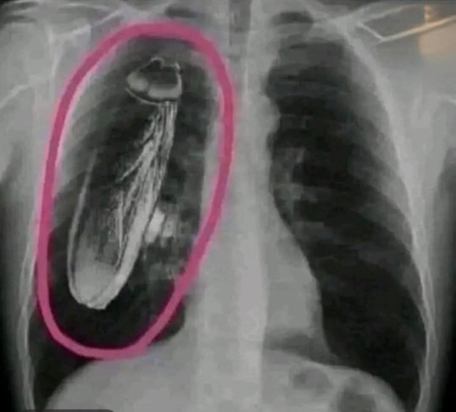 The patient was told 'There is a live insect in your chest', but the reality was very different