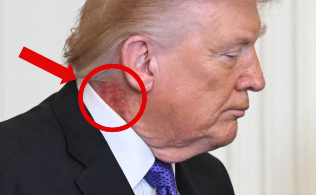 herkes trump in boynundaki yaraya odaklandi 19617943 3178 m