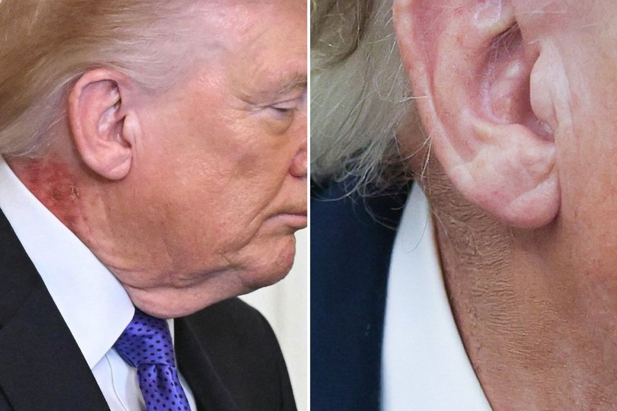 Trump'ın boynundaki kızarıklığı gizleme çabası