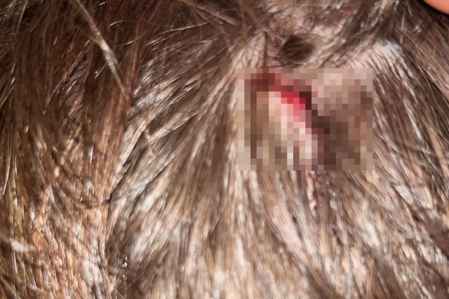 تتزايد العداوة في يالوفا: أصيب أيضًا الطفل البالغ من العمر 8 سنوات من نفس العائلة