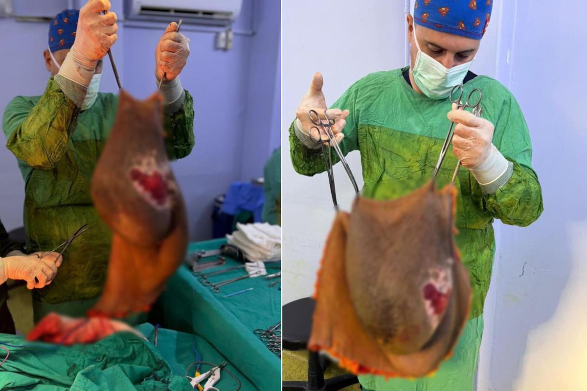 Bu kitle bir insanın karnından çıktı! Doktor tek başına kaldıramadı
