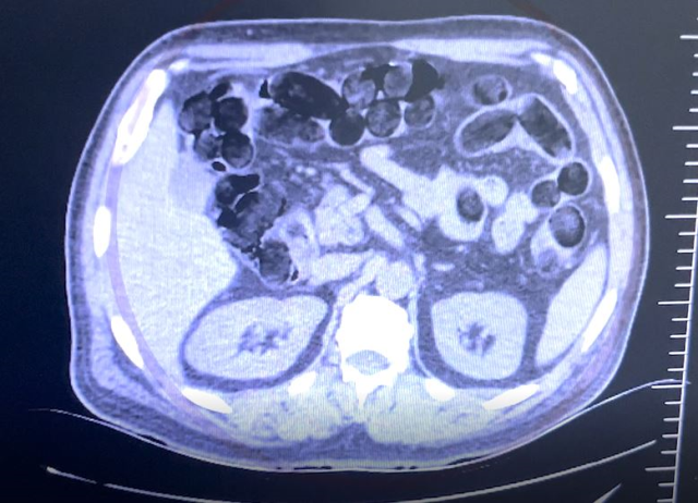 Drug couriers' stomachs operated