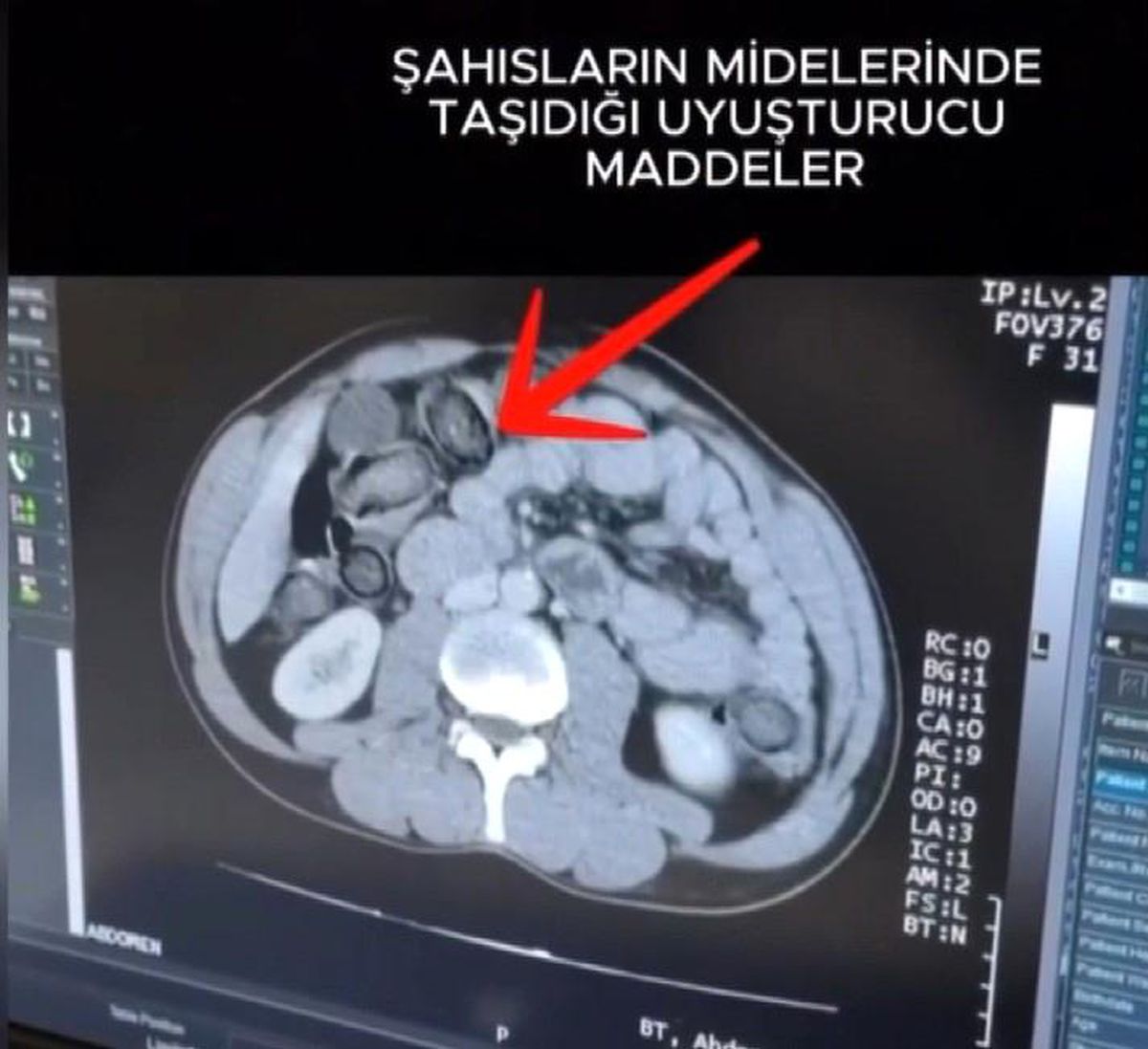 Mideye gizlenen uyuşturucu Erzincan'da ele geçirildi