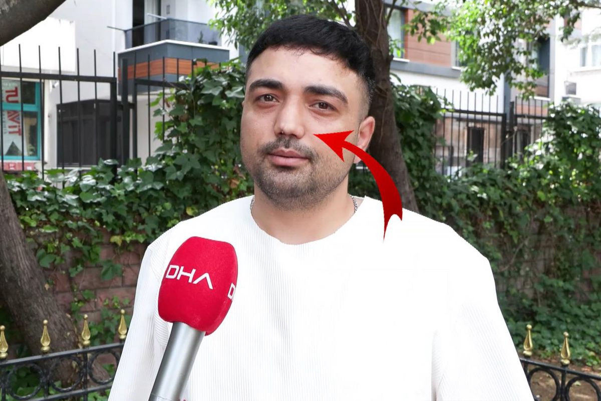 Burun ameliyatına girdi, başına gelmeyen kalmadı! İşini bile kaybetti