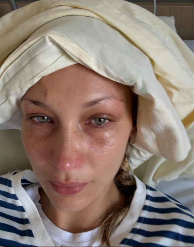Bella Hadid Lyme hastalığıyla mücadelesini anlattı