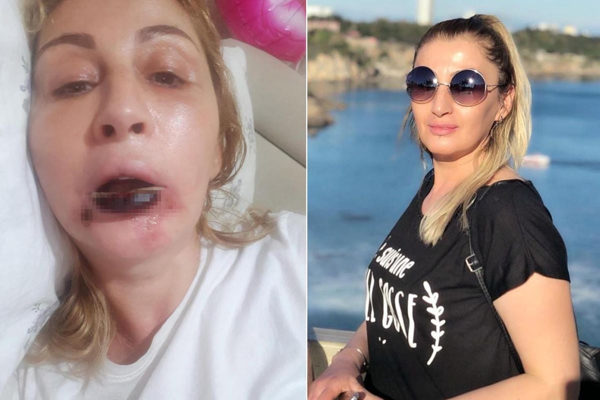 Estetik İşlem Sonrası Dudak Kaybı Davasında Tazminat Kararı