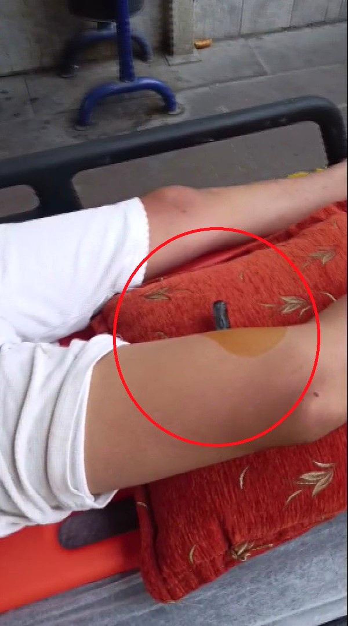 Hatay'ın Belen ilçesinde bacağına demir korkuluk saplanan bir çocuğun kurtarılma anı.