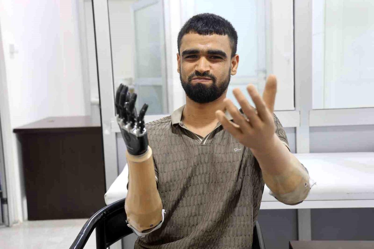 Demirin elektrik tellerine değmesiyle hayatı kararan Muhammed, 3 milyon TL değerindeki protez bacağına ve 2 biyonik koluna kavuştu