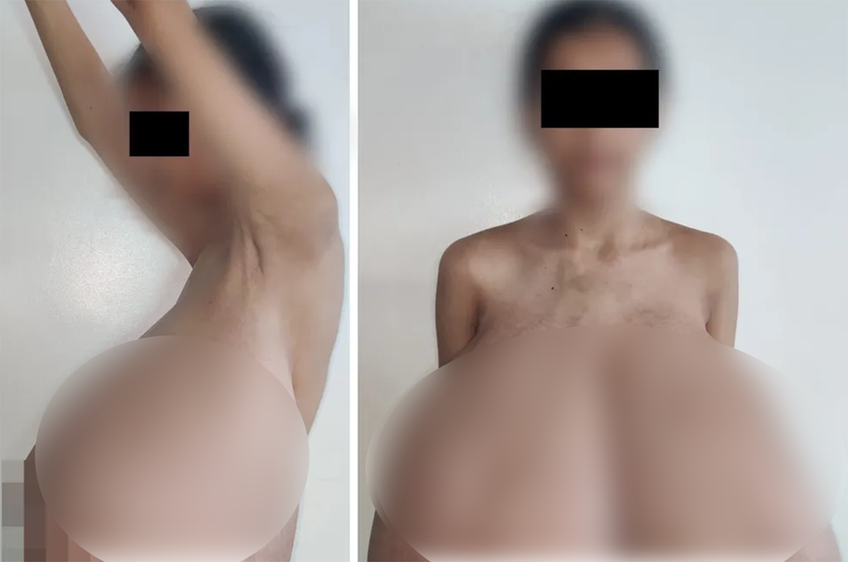 13 yaşında başladı! Göğüsleri vücut ağırlığının dörtte birine ulaştı