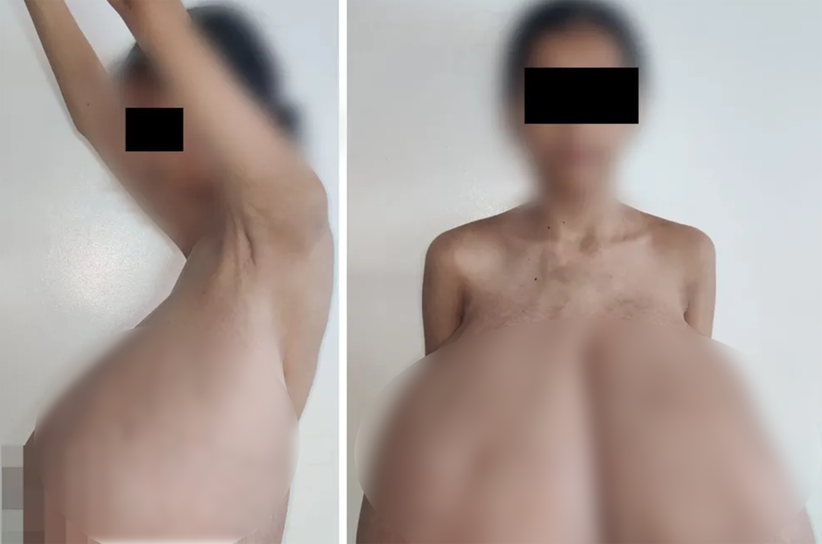 13 yaşında başladı! Göğüsleri vücut ağırlığının dörtte birine ulaştı