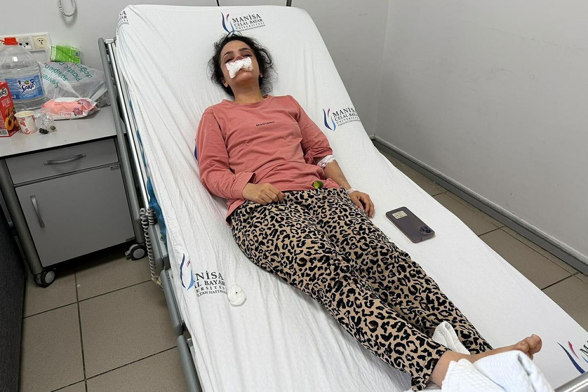 Eşinin ısırarak burnunu kopardığı kadının geldiği hale bakın