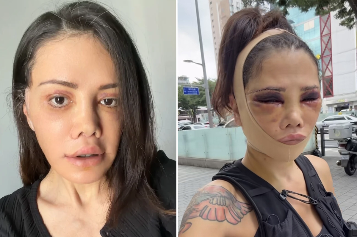 Didem Ceran'ın revizyon ameliyatı sonrası ağlayarak yaptığı açıklama