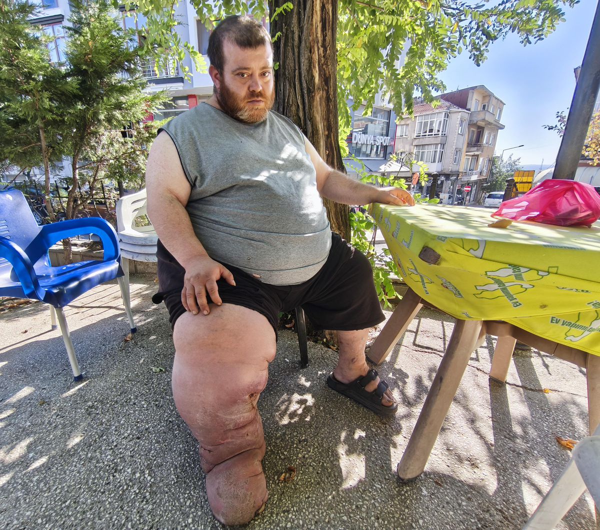 Fil hastalığıyla mücadelede 82 kilo vermesi gereken Kazım Atak'ın tedavi umudu