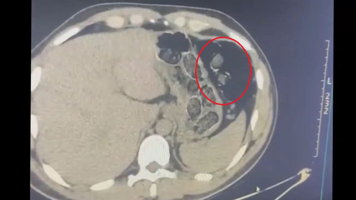 Midesinde 780 gram metamfetaminle yakalanan 2 şüpheli tutuklandı