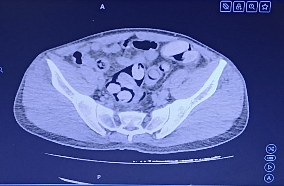 Midesinden 1 kilo uyuşturucu çıktı