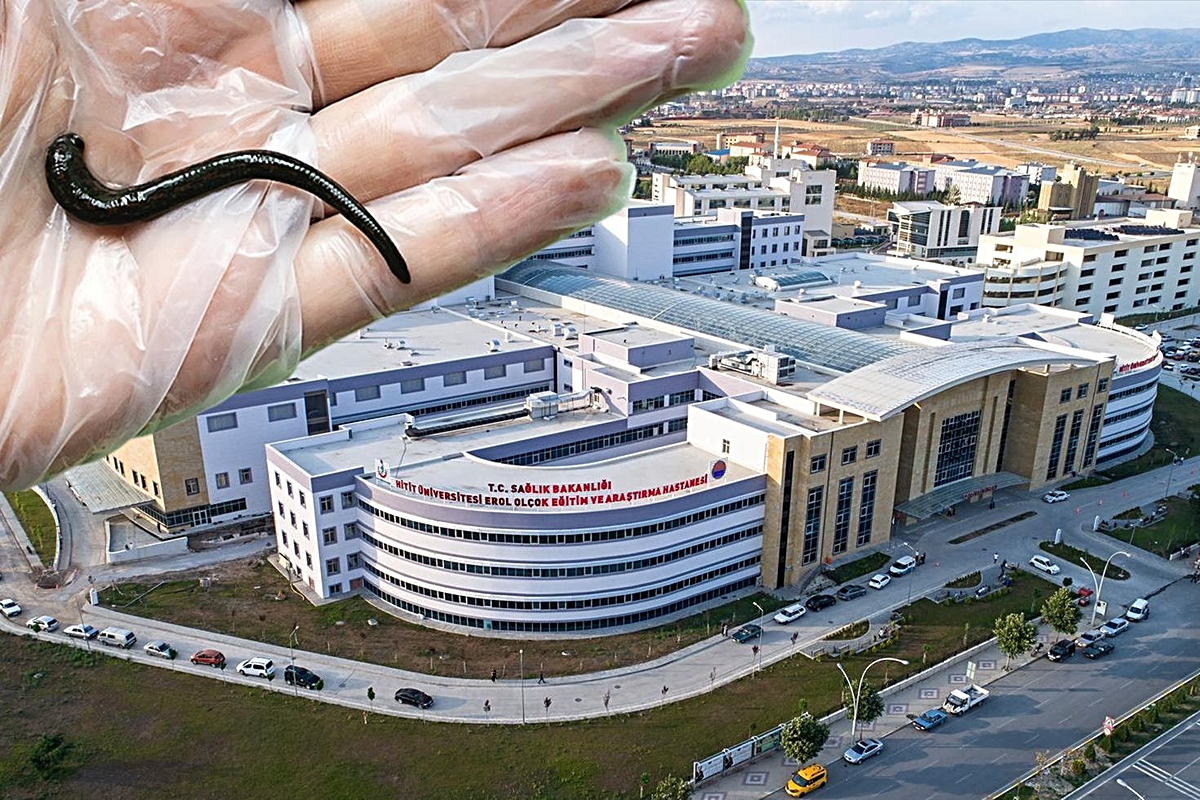 Çorum'da hastanın boğazından canlı sülük çıkarıldı! Köy çeşmesinden su içmiş