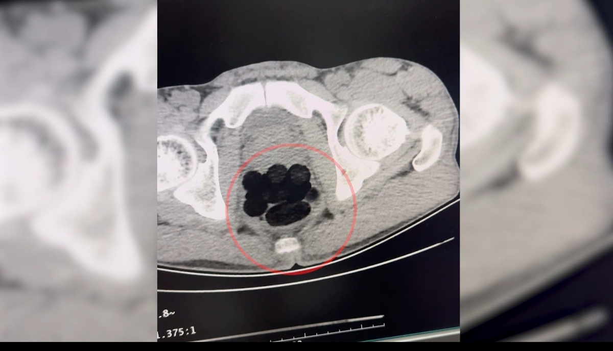 Batman'da yabancı uyruklu şüphelinin midesinden 253,22 gram eroin çıktı, tutuklandı
