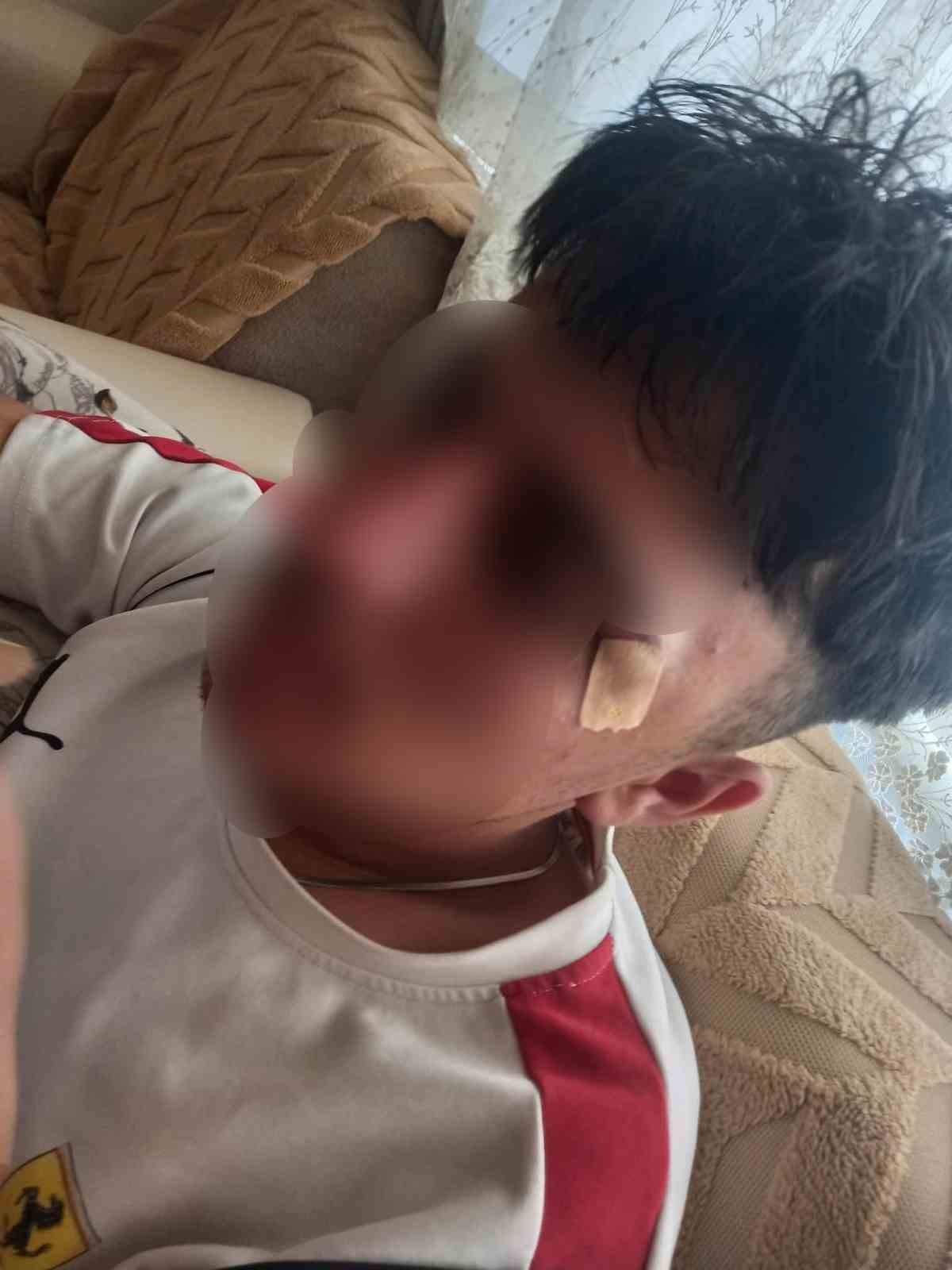 Afyonkarahisar'da 16 yaşındaki çocuğun burnu öğretmenin kafa atması iddiasıyla kırıldı