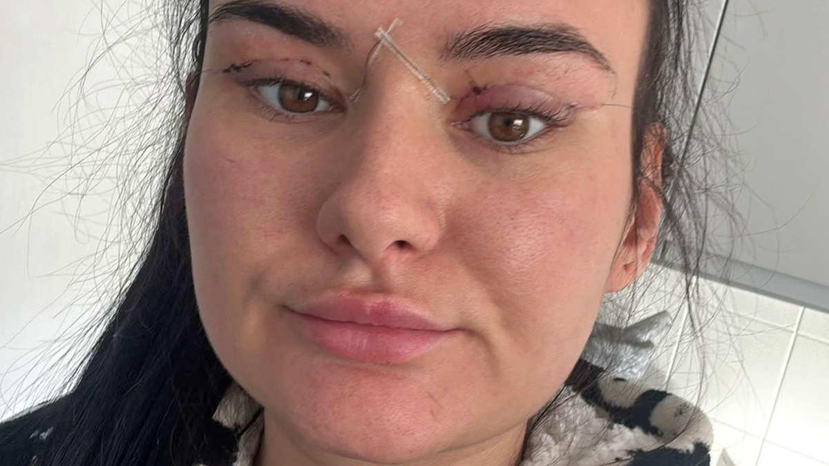 Yurtdışında ucuz göz kapağı ameliyatı komplikasyonları NHS'yi zorluyor