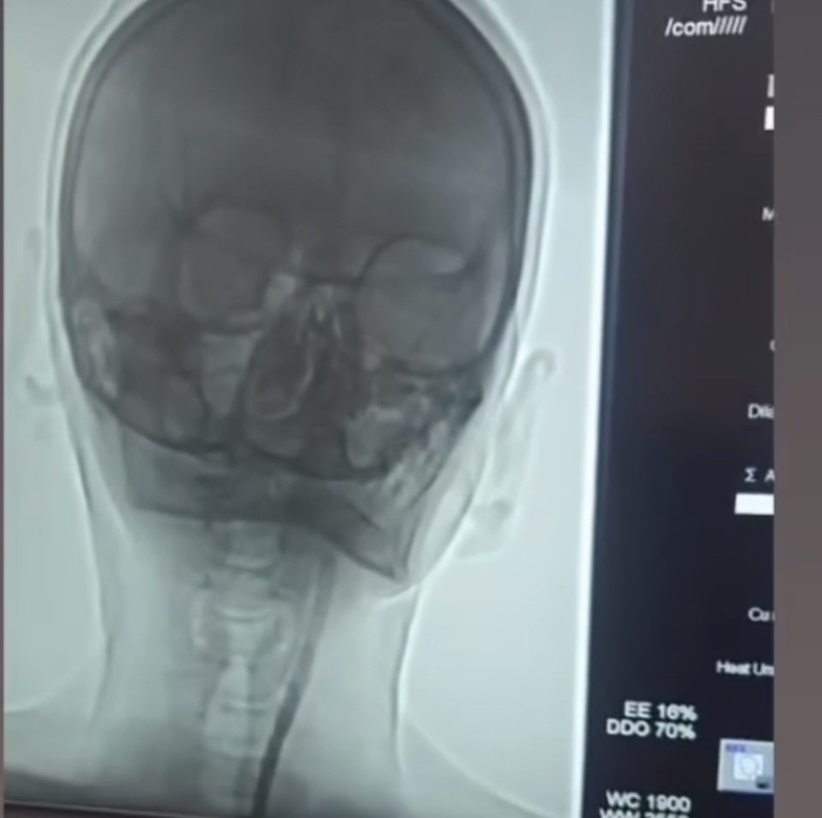 Şah damarı darlığına Iğdır'da stent takılan hasta şifa ile taburcu edildi