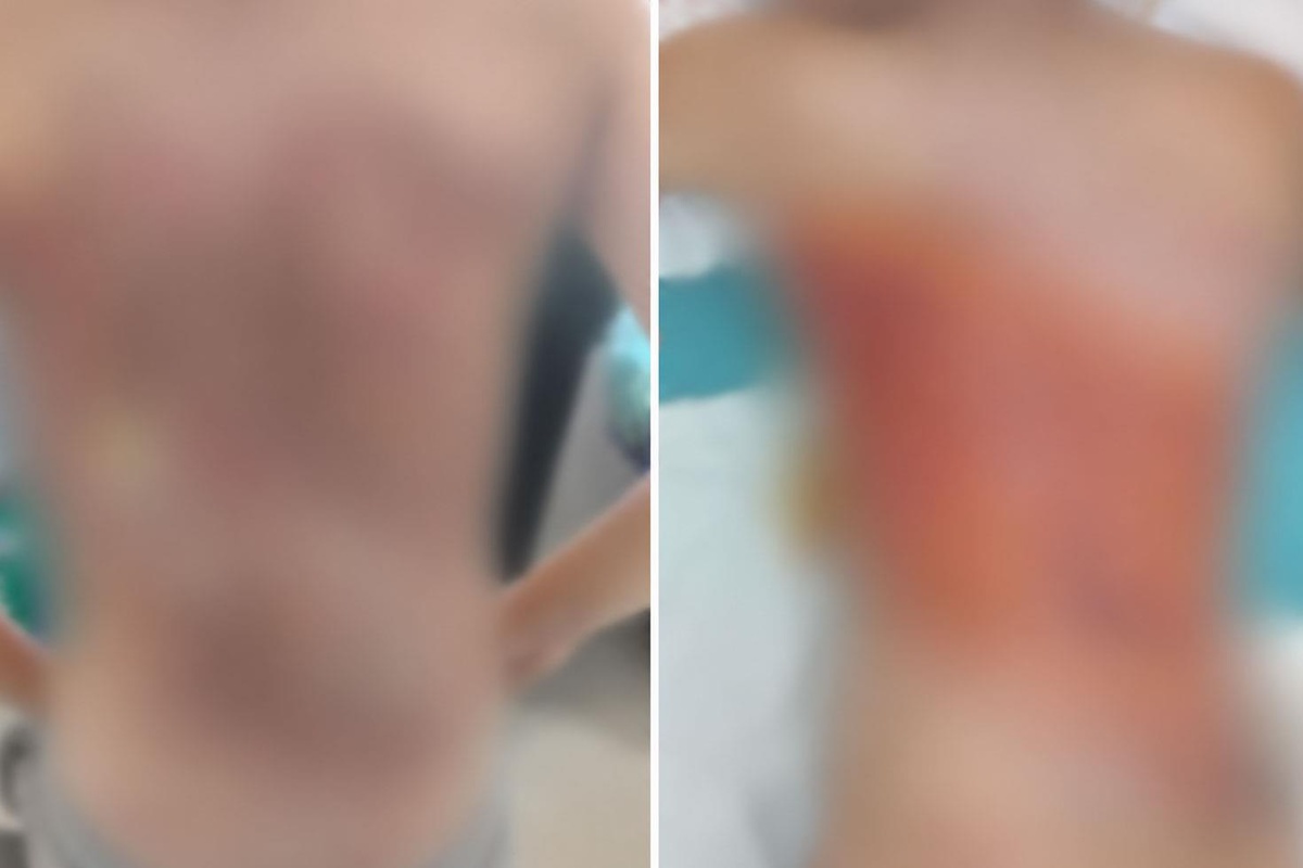 Arnavutköy'de akran zorbalığı iddiası: 12 yaşındaki çocuğun sırtını kolonya ile yaktılar