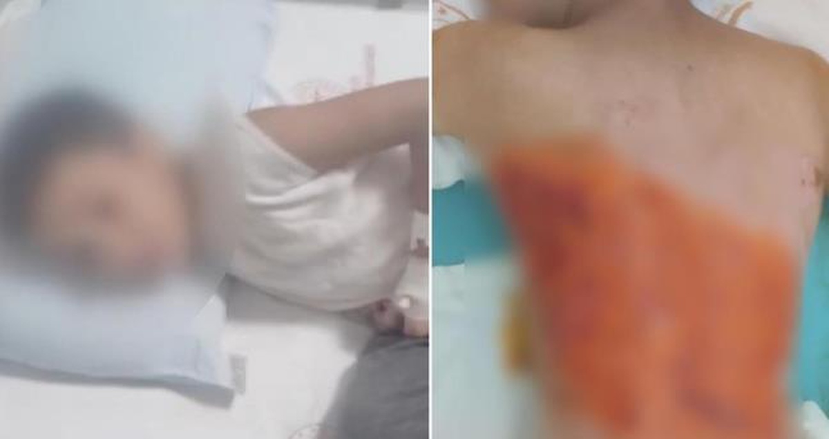ARNAVUTKÖY SON DAKİKA! 12 yaşındaki çocuğun yanması olayı nedir, kim yaptı?