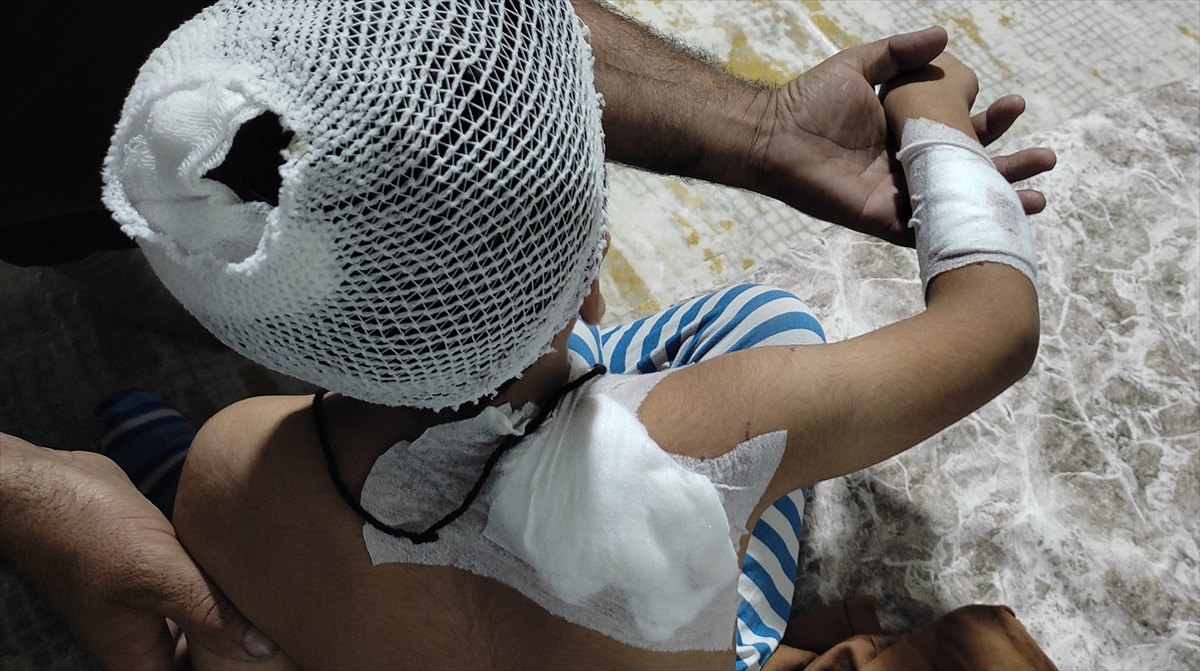 Şanlıurfa Viranşehir'de sahipsiz köpek saldırısından yaralanan çocuk taburcu edildi