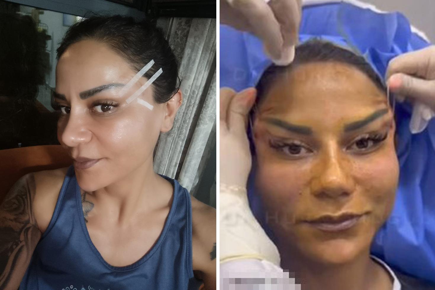 Kredi çekip estetik yaptırdı, hayatı güzellik uğruna kabusa döndü