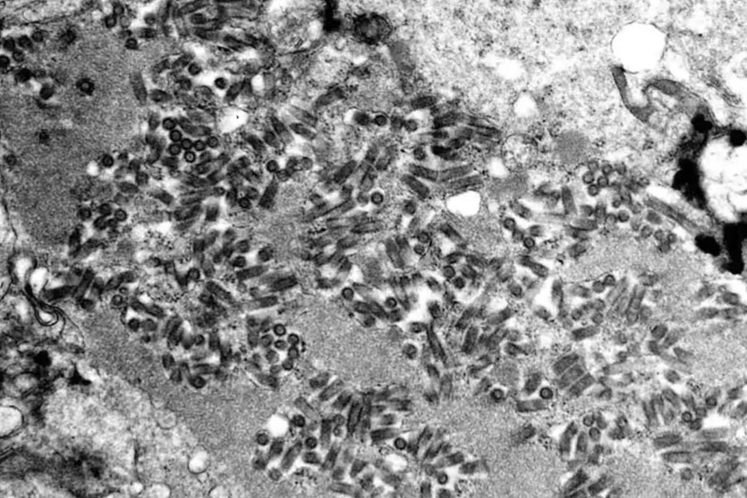 Bağışlanan organdan kuduz kapan adam hayatını kaybetti