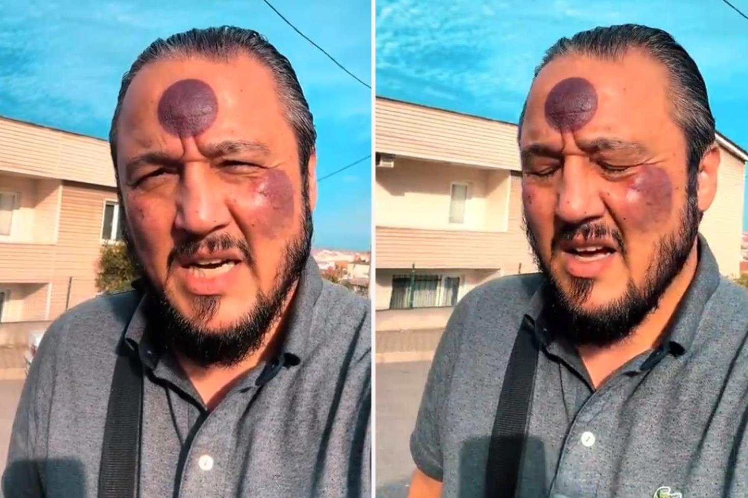 Yüzüne yaptırdığı işlemden sonra bu hale geldi, yine de savundu