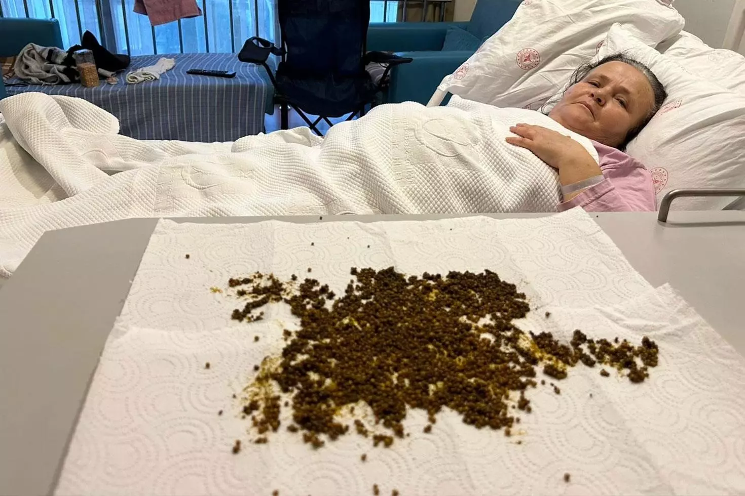 Karın ağrısı şikayetiyle gitti, safra kesesinden 20 bin taş çıkarıldı