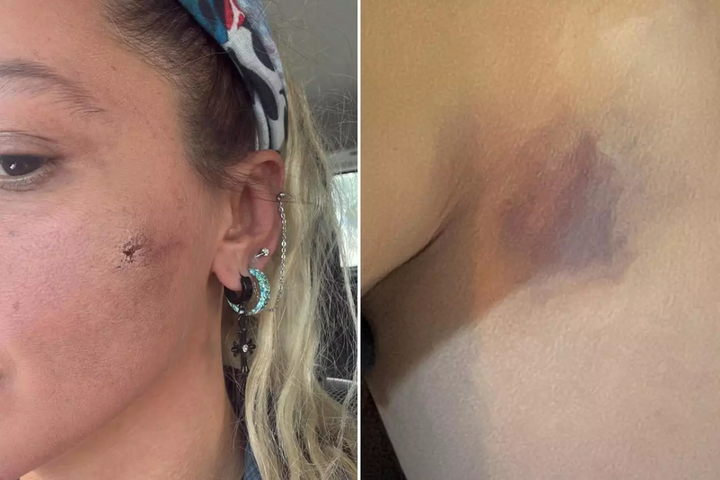 Yıldız Asyalı kocasından şiddet gördüğünü açıkladı