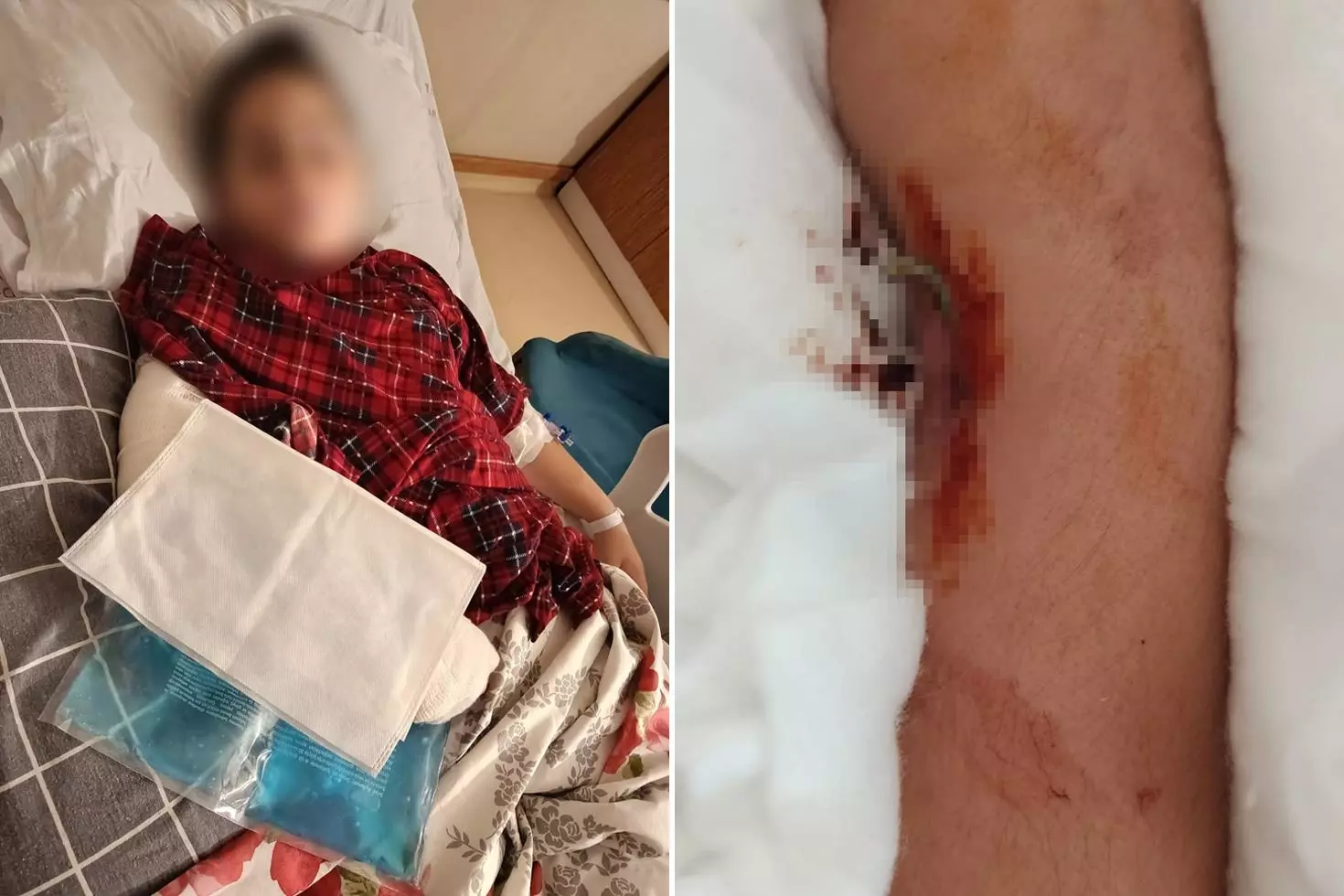 9 yaşındaki çocuk, 8 yaşındaki çocuğun kolunu kırarak intikam aldı