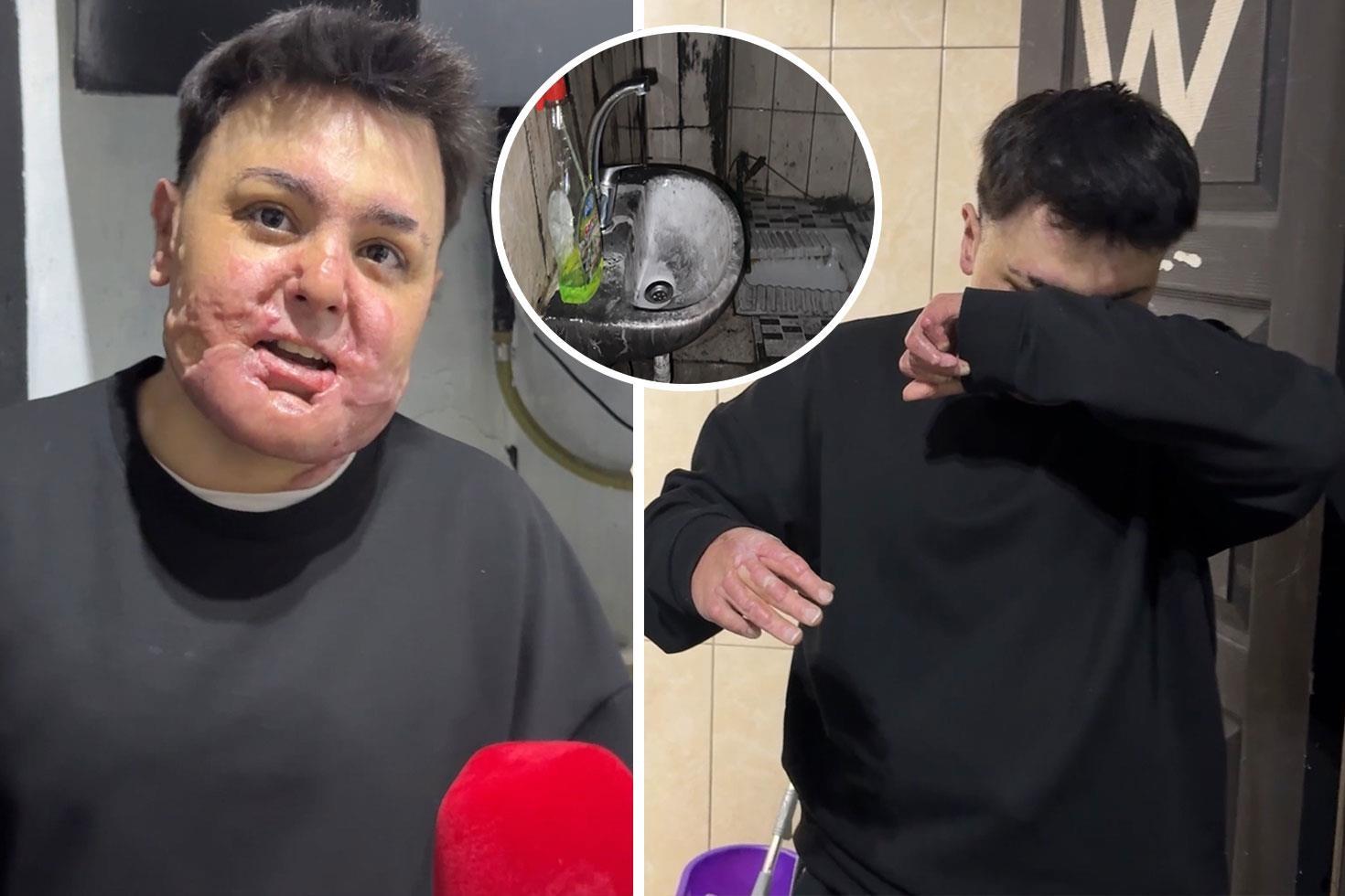 65 ameliyat geçirdi, 12 gün uyutuldu Hayatı saniyeler içinde kabusa döndü