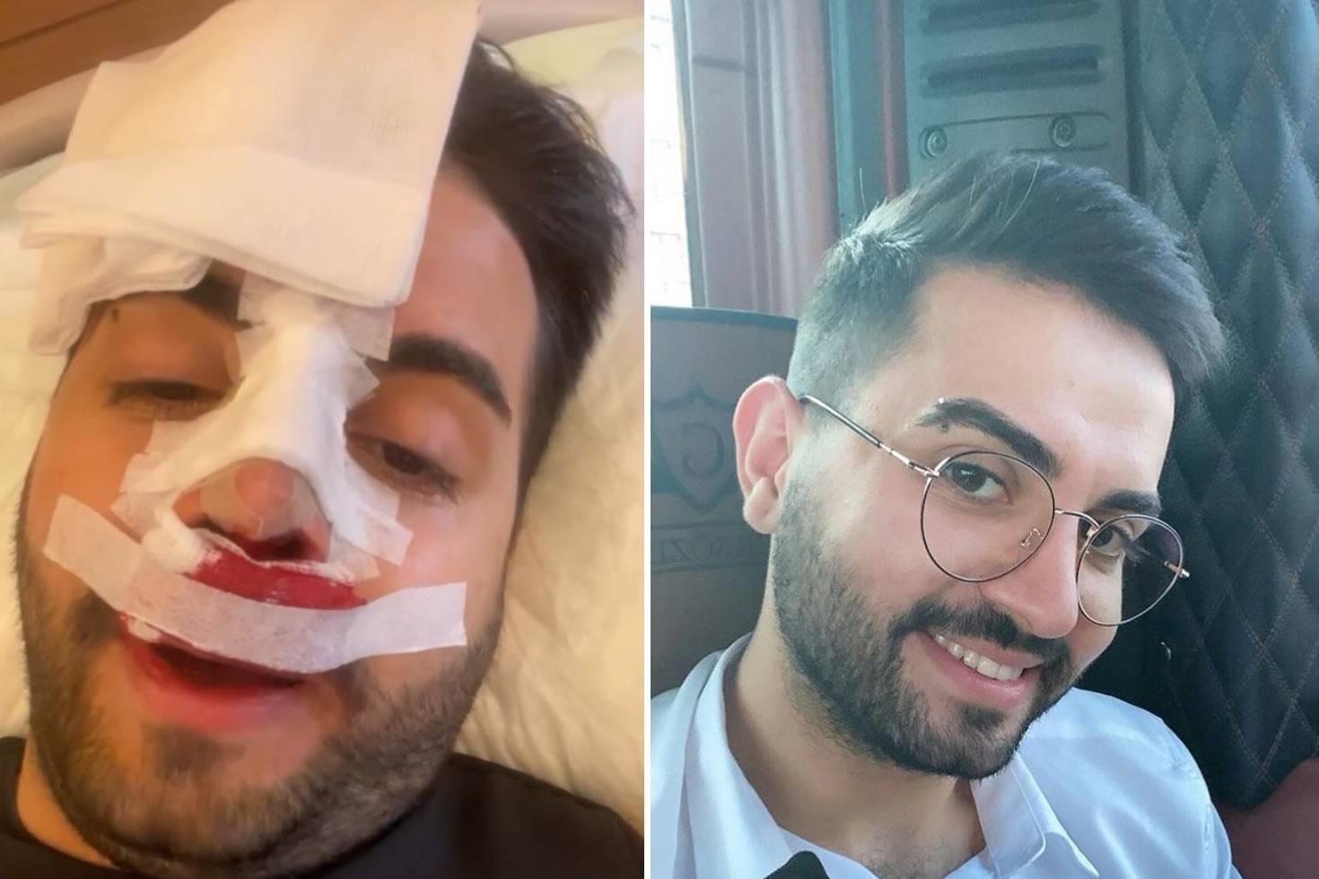 Kadir Ezildi burnu sargılı fotoğrafıyla korkuttu Gerçek sonradan ortaya çıktı