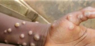 M çiçeği virüsü o ülkede ilk kez görüldü