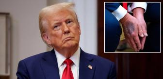 Eline ne oldu? Trump morlukların sebebini ilk kez açıkladı