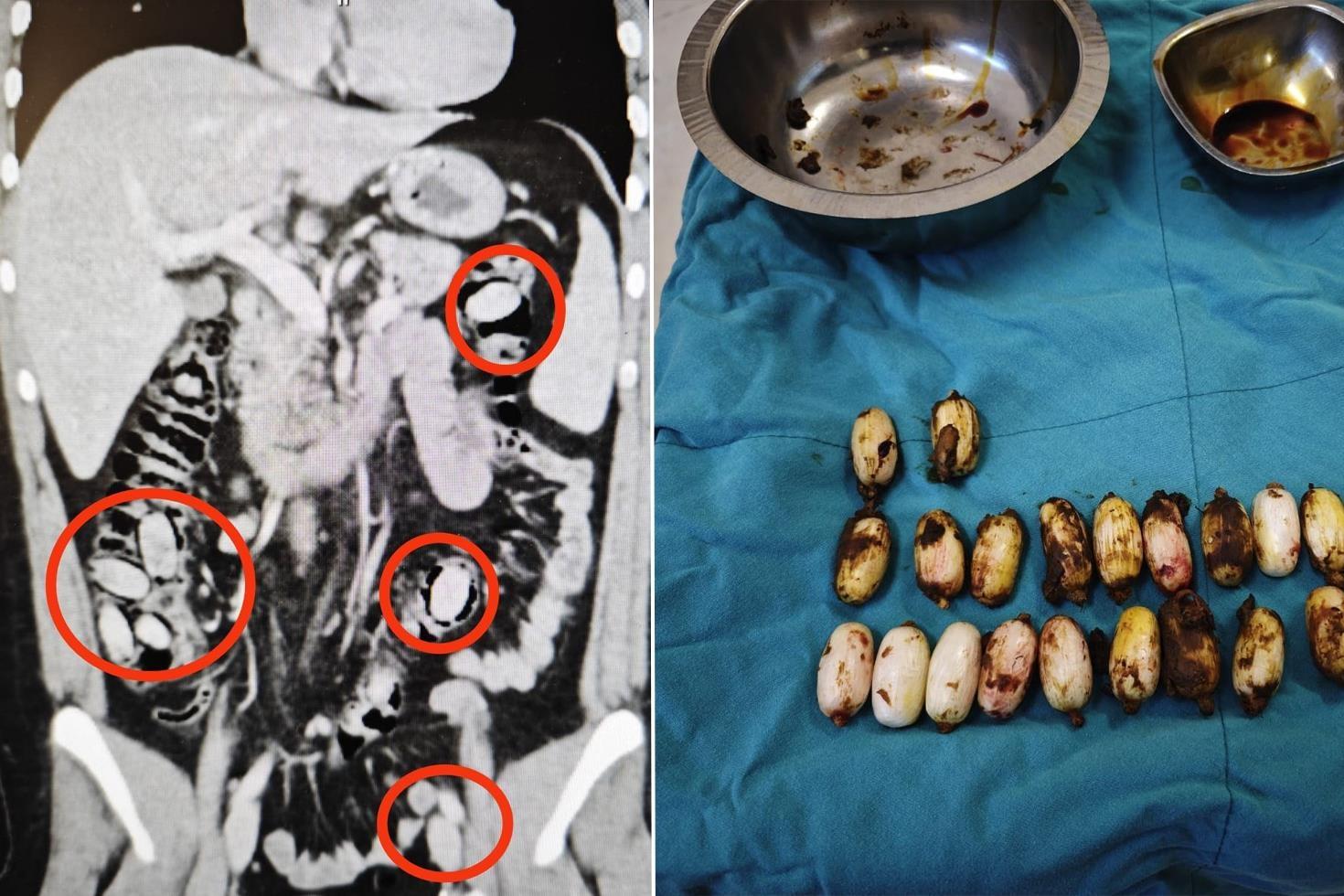 Eskişehir’de polisin durdurduğu şahsın midesinden çıkanlar şoke etti