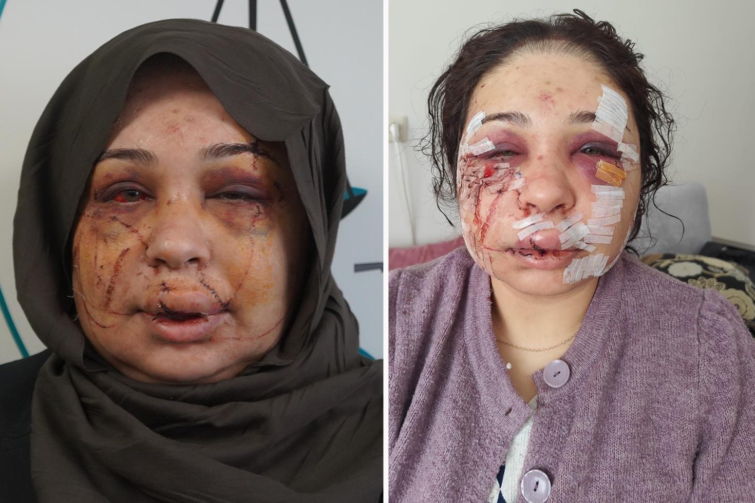 Polis eşi tarafından darbedildiği iddiasıyla şikayetçi oldu