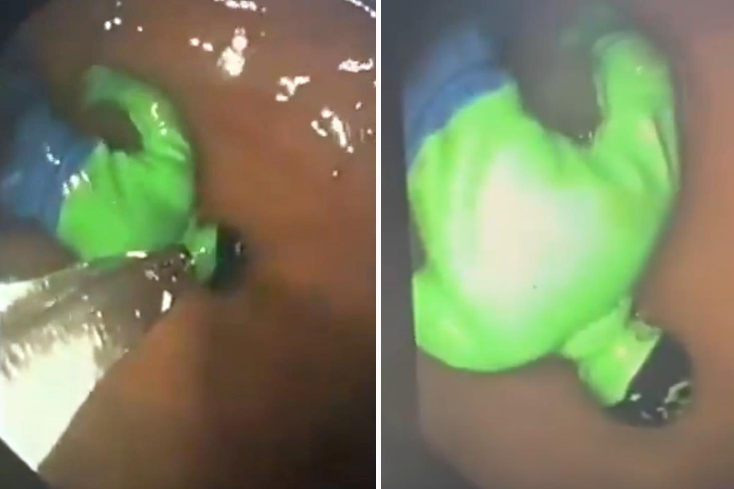 Hindistan’da çocuğun midesinden “hulk“ çıktı