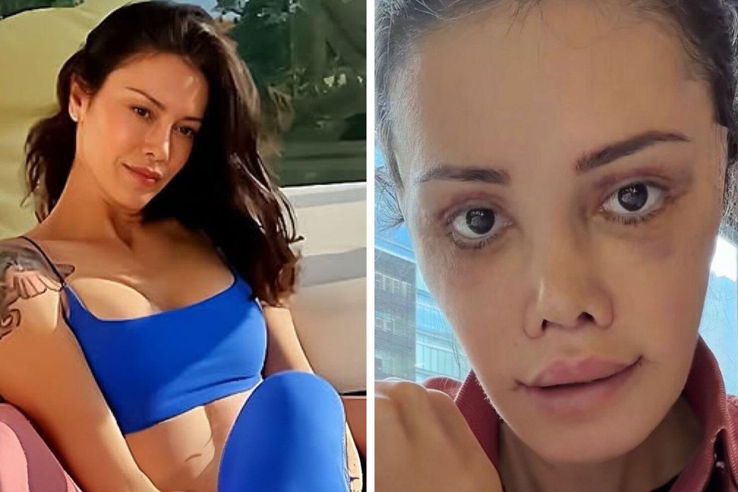 Yüz nakli yaptıran Didem Ceran’ın son hali: Harika gözüküyorum